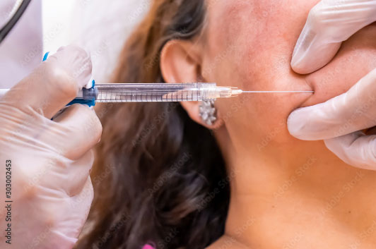 Juvederm